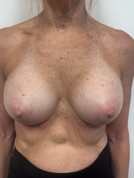 After Image: Breast Augmentation - front