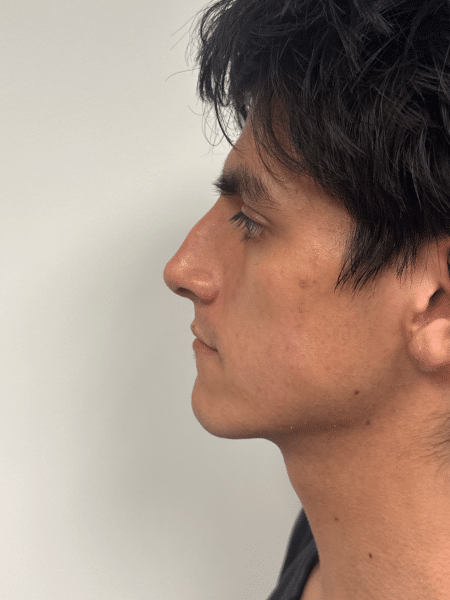 Before Image: Rhinoplasty - left-side