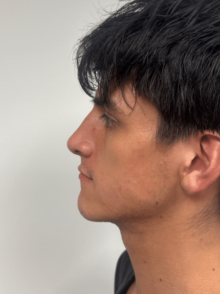 After Image: Rhinoplasty - left-side