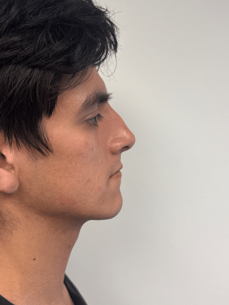Before Image: Rhinoplasty - right-side