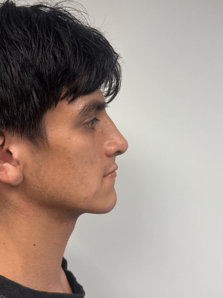 After Image: Rhinoplasty - right-side
