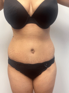 After Image: Abdominoplasty