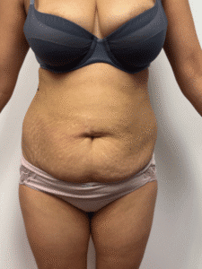 Before Image: Abdominoplasty