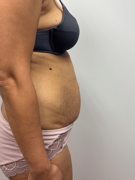 Before Image: Abdominoplasty - right-side