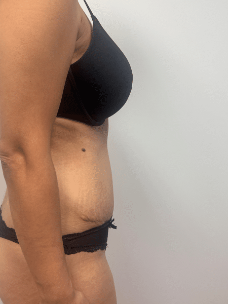 After Image: Abdominoplasty - right-side