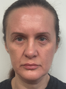 After Image: Blepharoplasty