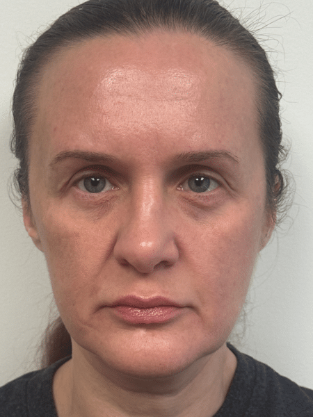 After Image: Blepharoplasty - front