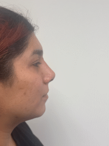 After Image: Rhinoplasty