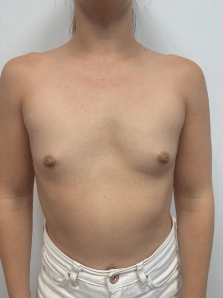 Before Image: Breast Augmentation - front