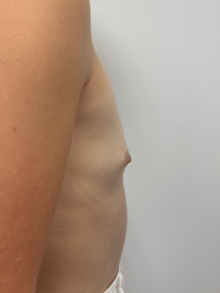 Before Image: Breast Augmentation - right-side