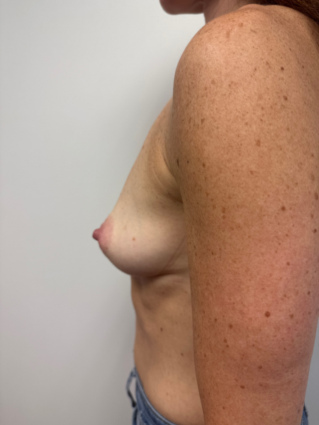 Before Image: Breast Augmentation - left-side