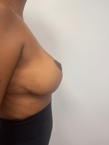 After Image: Breast Lift - right-side