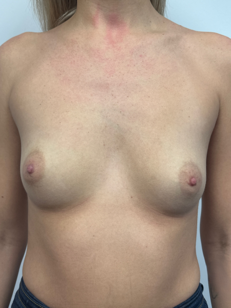 Before Image: Breast Augmentation - front