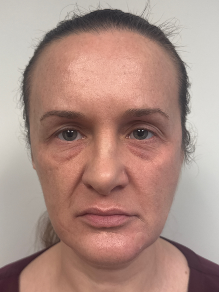 Before Image: Blepharoplasty - front