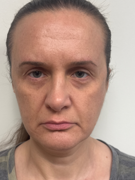 After Image: Blepharoplasty - front