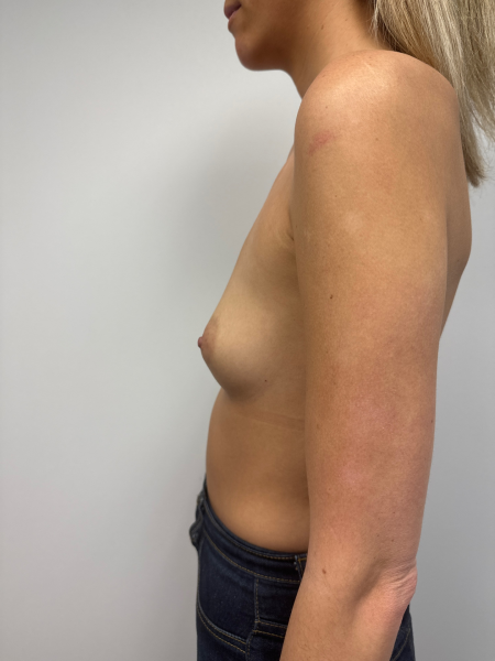 Before Image: Breast Augmentation - left-side