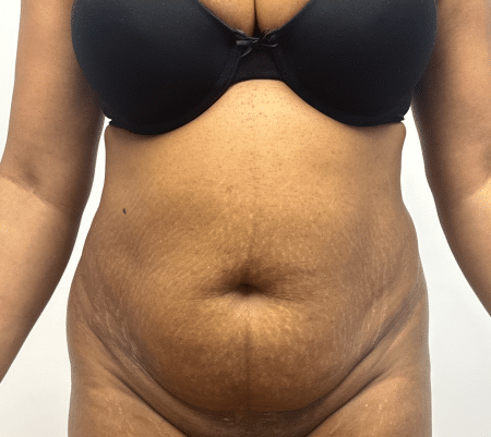 Before Image: Abdominoplasty - front