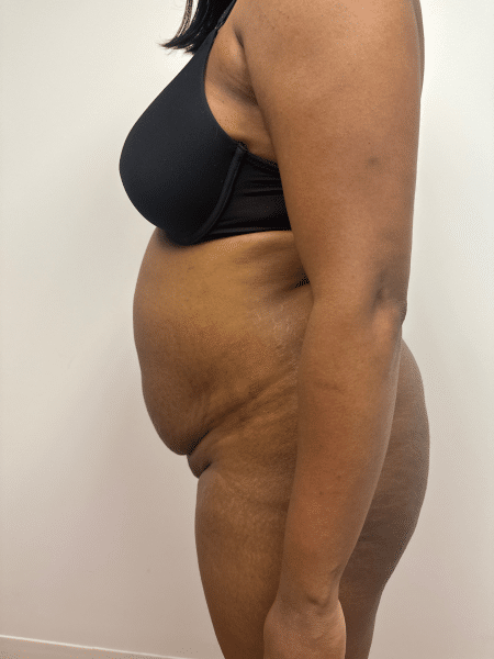 Before Image: Abdominoplasty - left-side