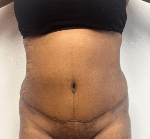 After Image: Abdominoplasty