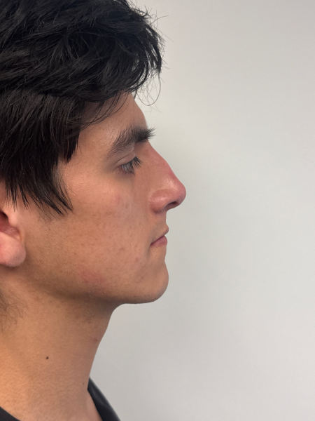 Before Image: Rhinoplasty - right-side