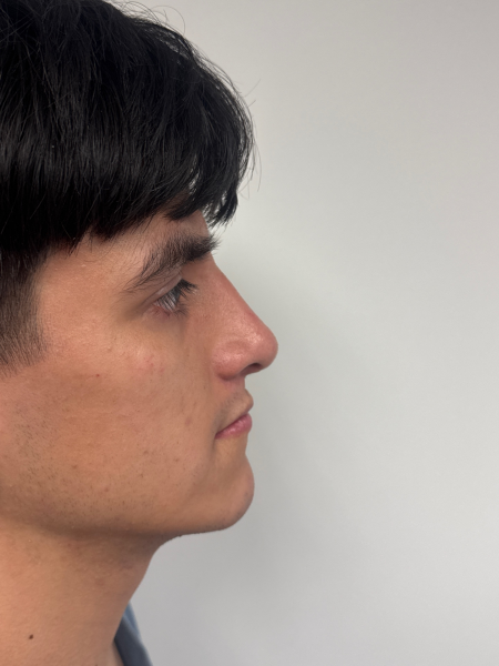 After Image: Rhinoplasty - right-side