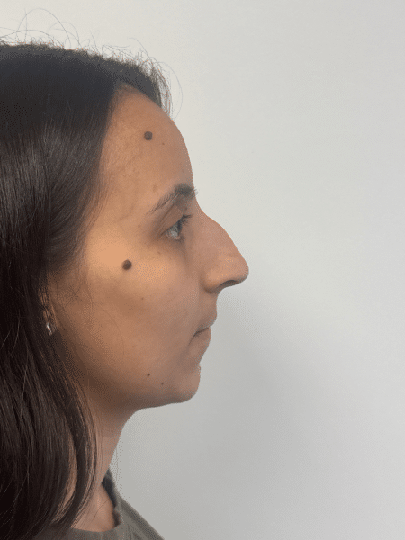 Before Image: Rhinoplasty - right-side