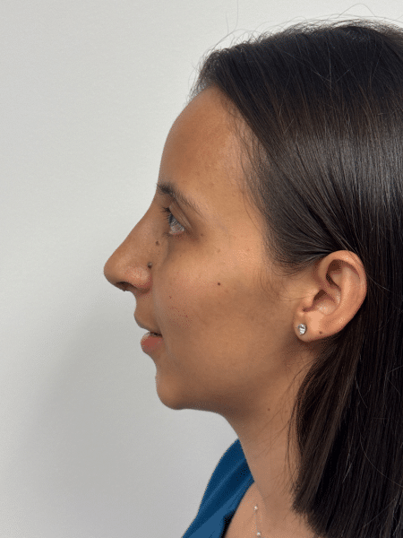 After Image: Rhinoplasty - left-side