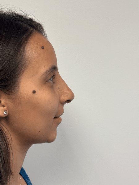 After Image: Rhinoplasty - right-side