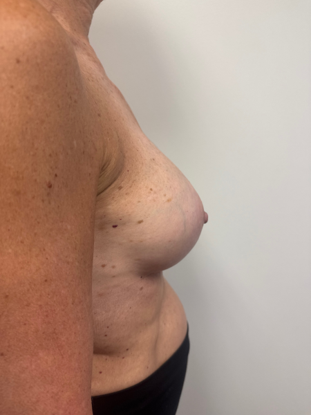 After Image: Breast Augmentation - right-side