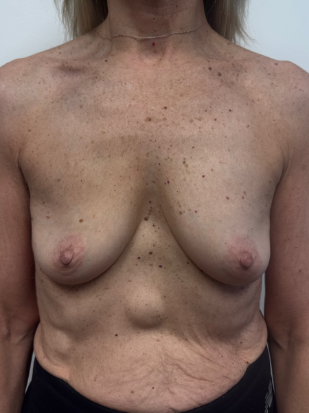 Before Image: Breast Augmentation - front