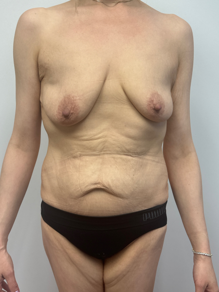 Before Image: Mommy Makeover - front