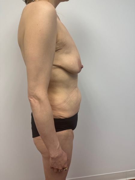 Before Image: Mommy Makeover - right-side