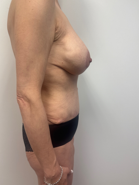 After Image: Mommy Makeover - right-side