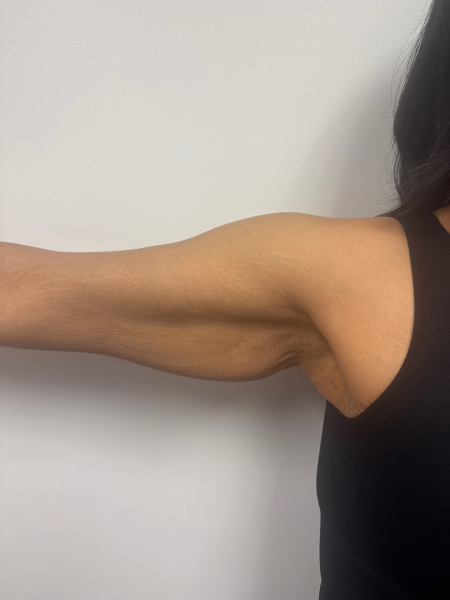 Before Image: Arm Lift - front