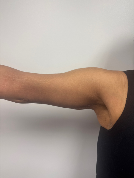 After Image: Arm Lift - front