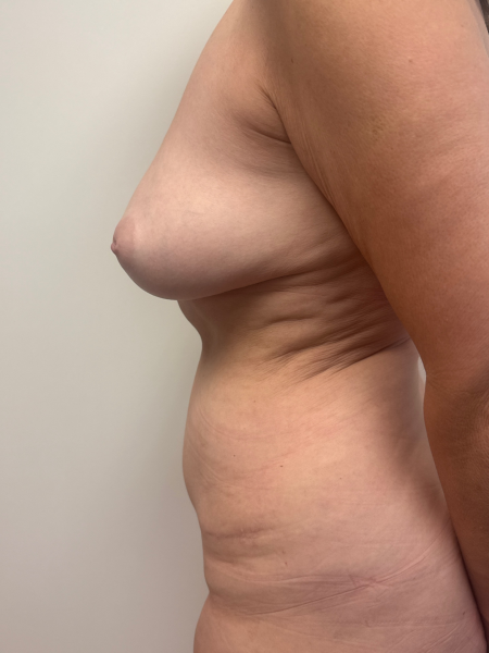 After Image: Abdominoplasty - back