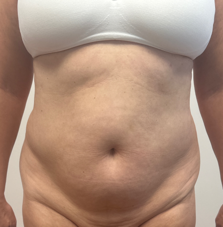 Before Image: Abdominoplasty - front