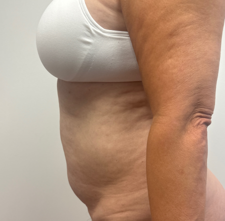 Before Image: Abdominoplasty - back