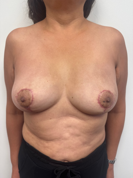 After Image: Breast Lift - front