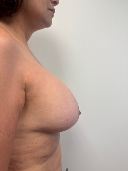 Before Image: Breast Lift - back