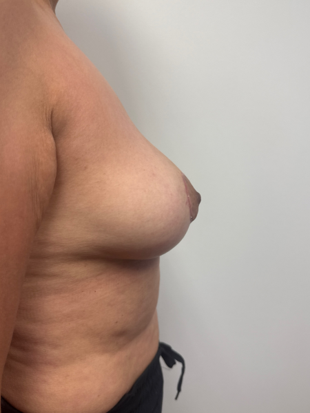 After Image: Breast Lift - back