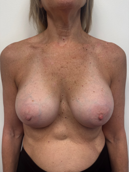 After Image: Breast Augmentation - front