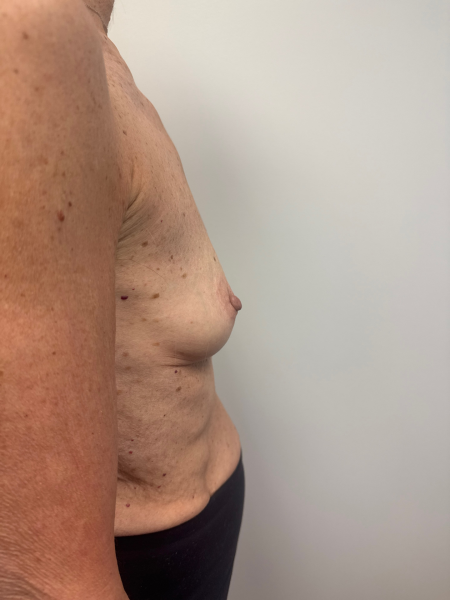 Before Image: Breast Augmentation - right-side