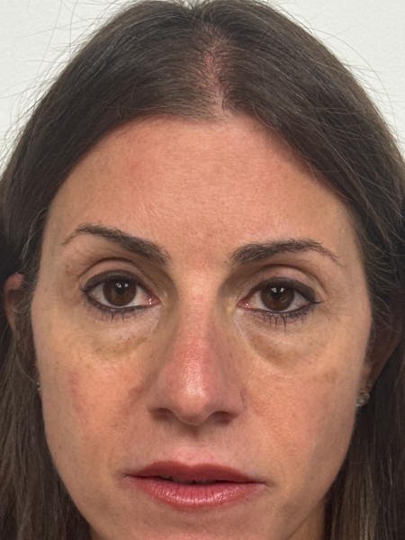Before Image: Blepharoplasty - front