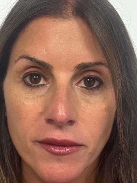 After Image: Blepharoplasty - front