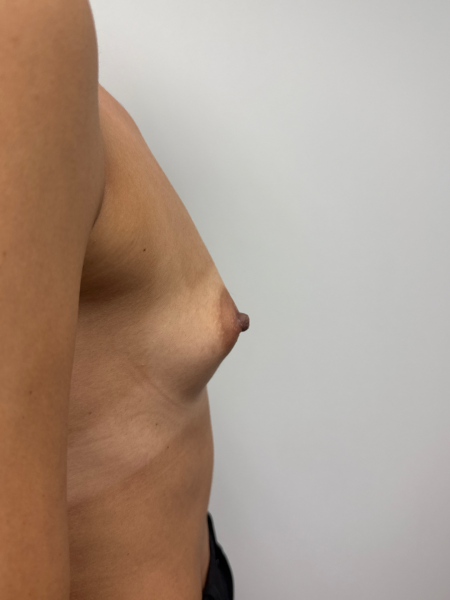 Before Image: Breast Augmentation - back
