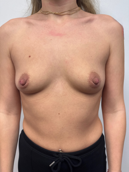 Before Image: Breast Augmentation - front