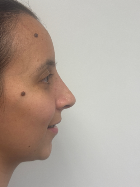 After Image: Rhinoplasty - right-side