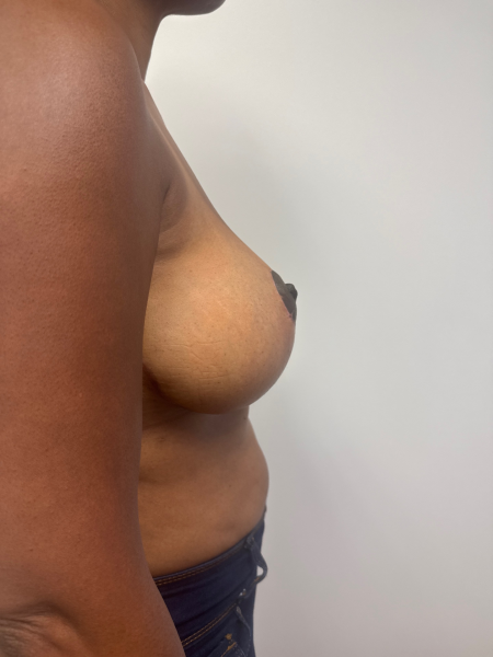 After Image: Breast Reduction - back