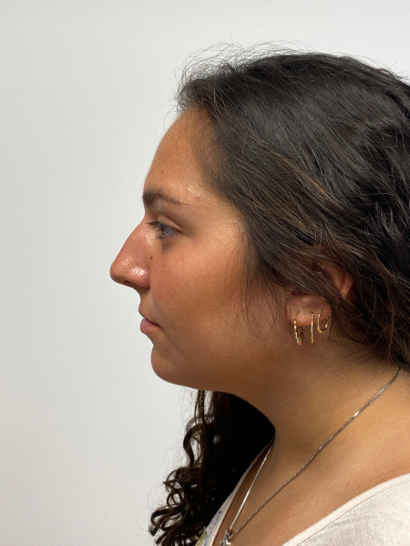 Before Image: Rhinoplasty - left-side
